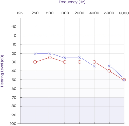 audiogram