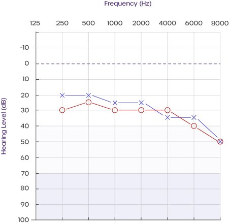 audiogram