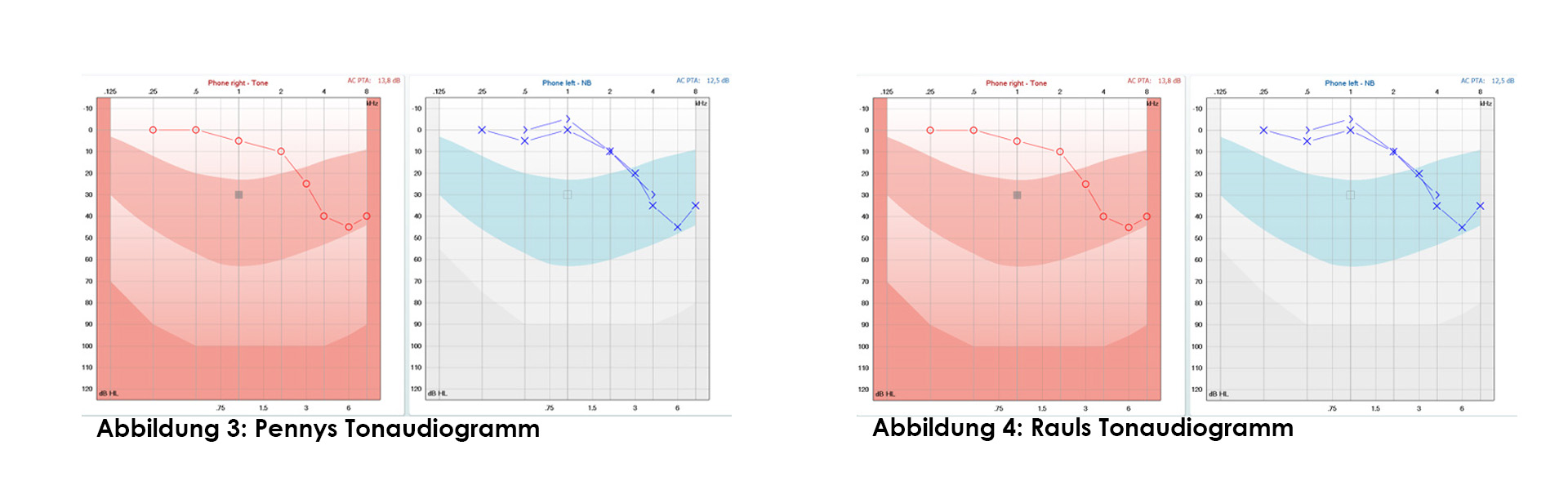Audible Contrast Threshold (ACT) Test