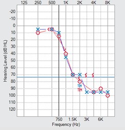 ten-test-audiogram