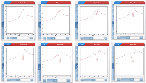 Tympanogram examples