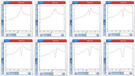 Tympanogram examples