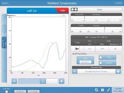 Type c tympanogram example for WideBand Tympanometry
