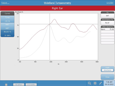 An absorbance graph during ossicular discontinuity