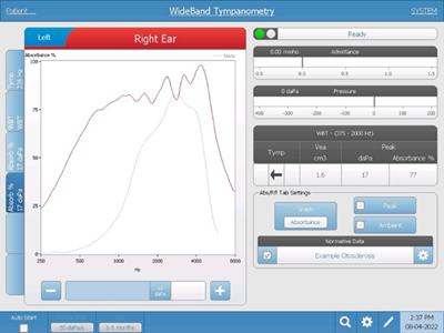 An absorbance graph consistent with otosclerosis