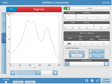 Typical absorbance for someone with a type A tympanogram