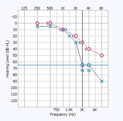ten-test-audiogram