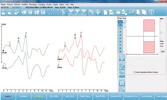 Evoked potentials testing screen