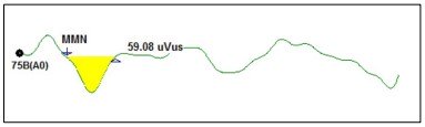 MMN Waveform Graph