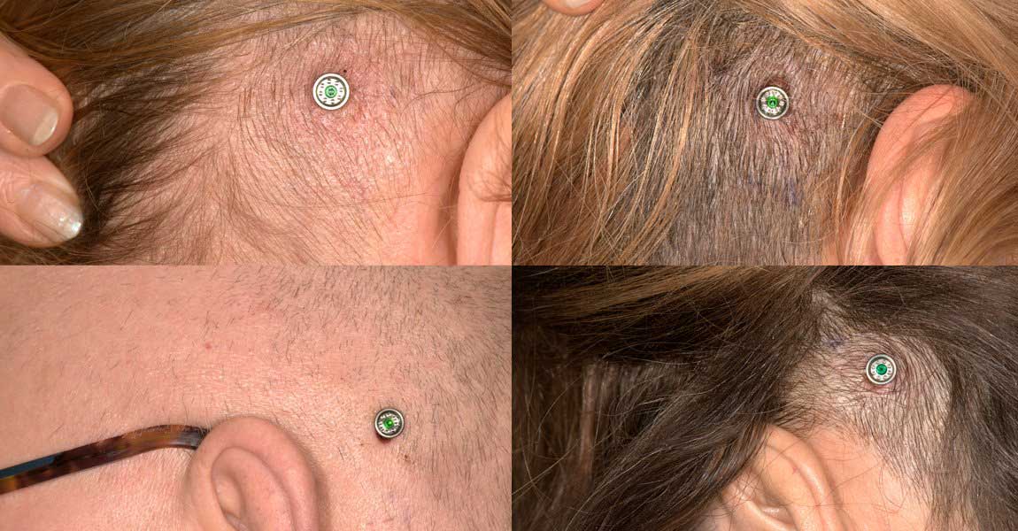 Ponto implants have been designed for tissue preservation