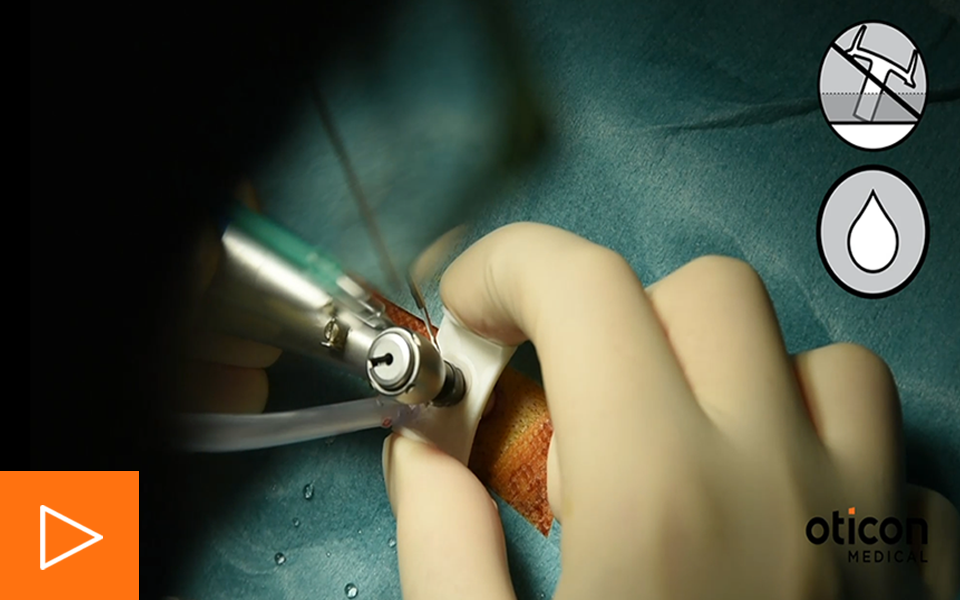 960x600-mono-procedure-step-by-step-video