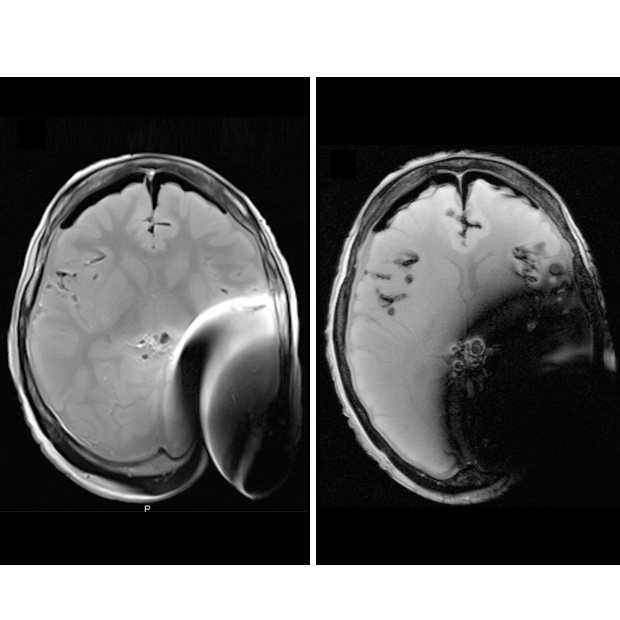 620x620-mri-f1