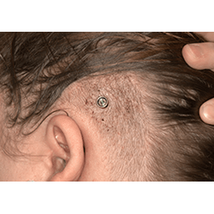 MIPS - 1 week post-op