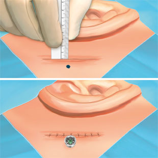 310x310-linear-incision-surgery-video