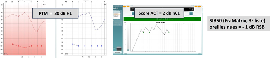 audiometrie