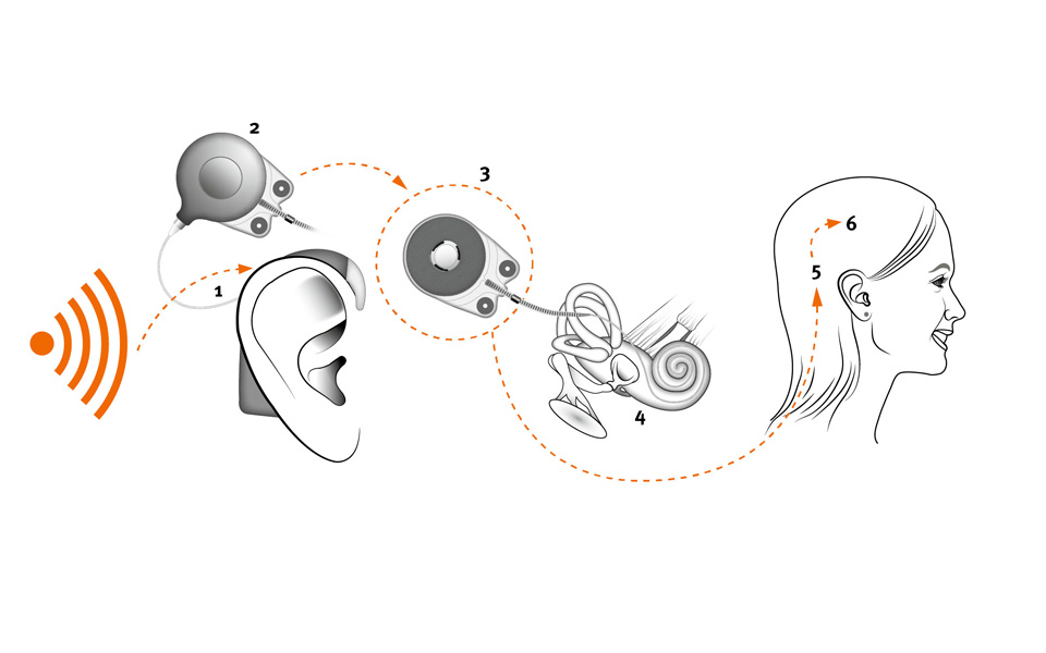 Cochlear Implementation Cochlear Implant Diagram Cochlear Implant An Overview