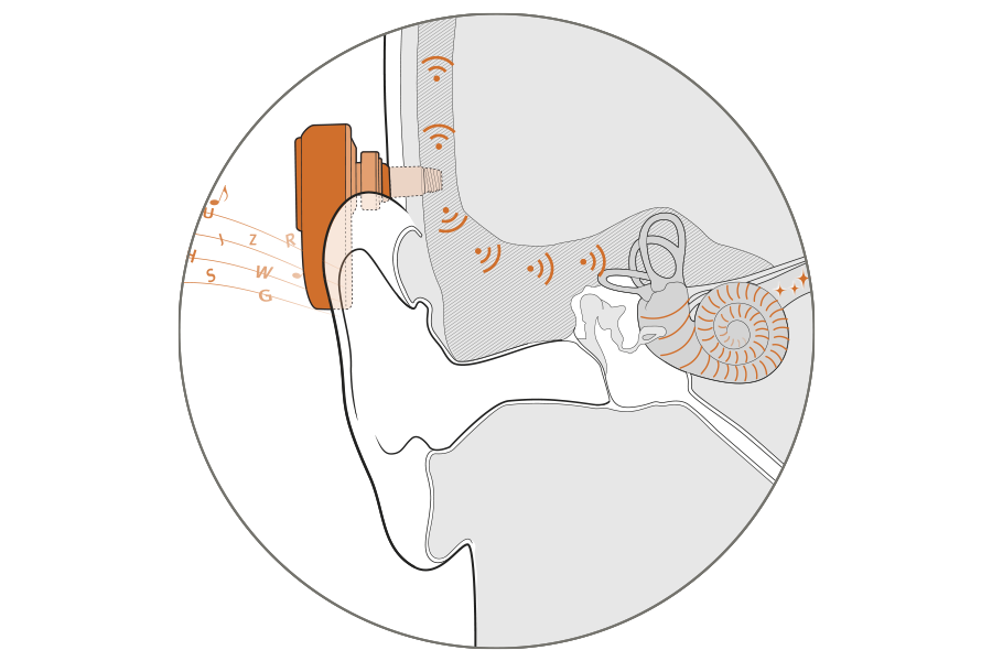 The Ponto system bypasses ear canal and middle ear problems