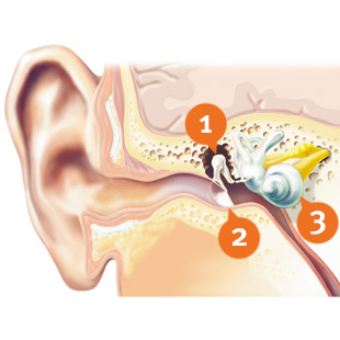 Mixed hearing loss