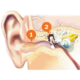 Conductive hearing loss
