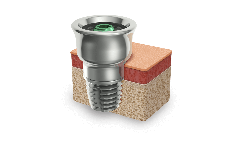 A skin-friendly abutment concept