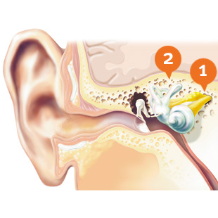 Sensorineural hearing loss