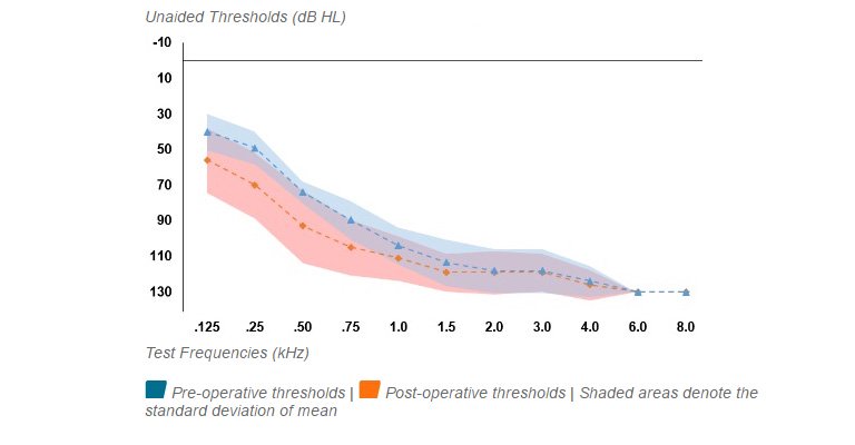 Average Pre vs. Post-op hearing thresholds