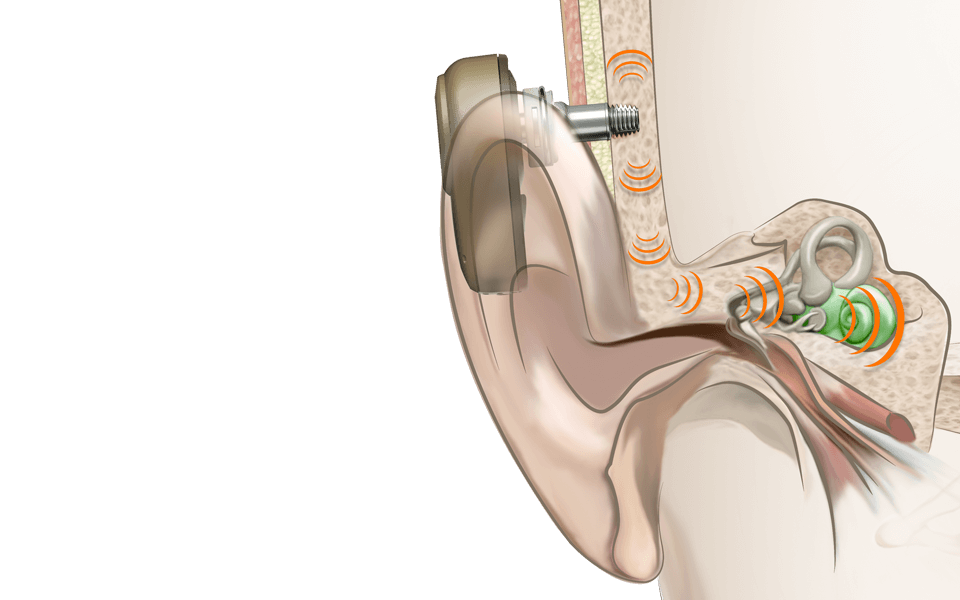 What is bone conduction - how does it work