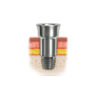 Early clinical outcomes of the Ponto implant system