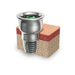 Read more about the Brånemark principle of osseointegration