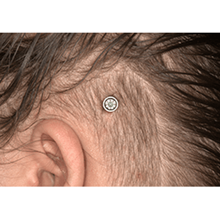 MIPS - A minimally invasive surgery without sutures or scarring